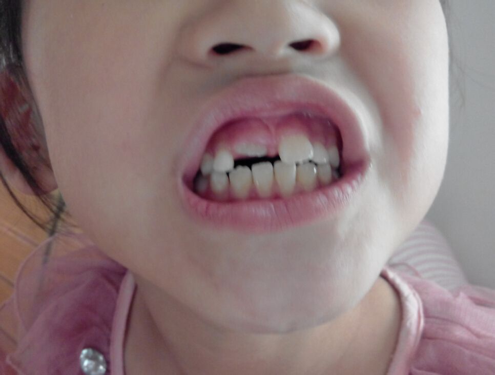 儿童牙齿矫正是在未满15周岁通过正畸或外科手术等方法治疗错颌畸形